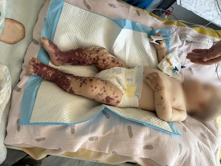 У Чернівцях врятували немовля, яке опинилося між життям і смертю через інфекцію